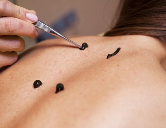 Гирудотерапия - Санаторий «Валуево»